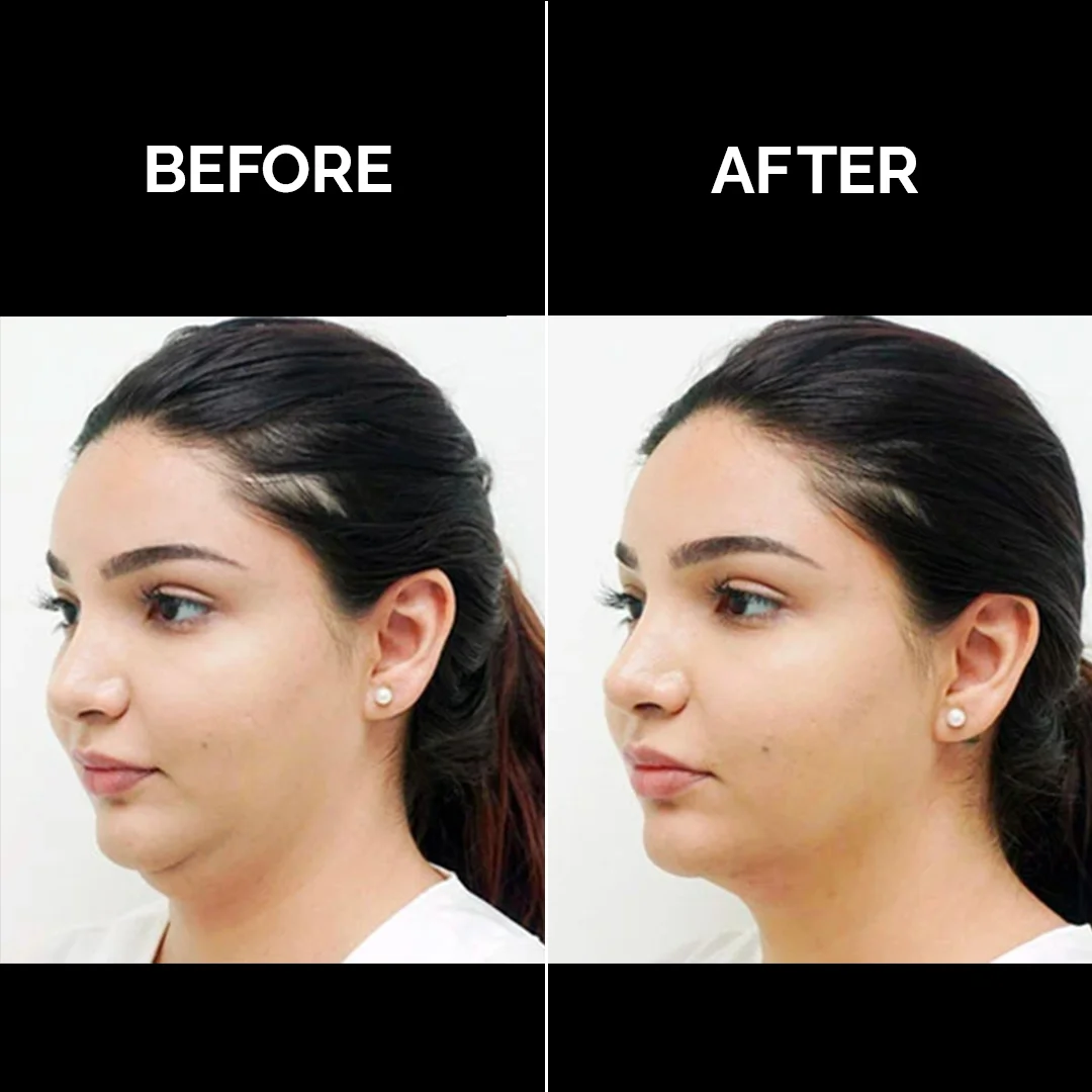 Jawline Contouring HIFU